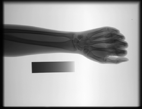 The Application of Bone Mineral Density Measurement in Digital Radiography System